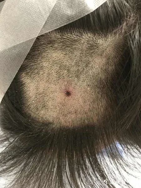 女子睡觉时被虫咬断一大把头发，原因、预防与应对措施